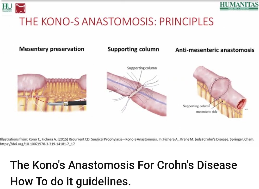 ColorectalDis's tweet photo. #CoDiSundays 📖☕

@escp_tweets and @ColorectalDis watch the video on how to do #Kono-s anastomosis. Watch with us  here👇🏽👇🏿👇👇🏽

https://t.co/kGPnOTKBsj https://t.co/QTOy27ybWX