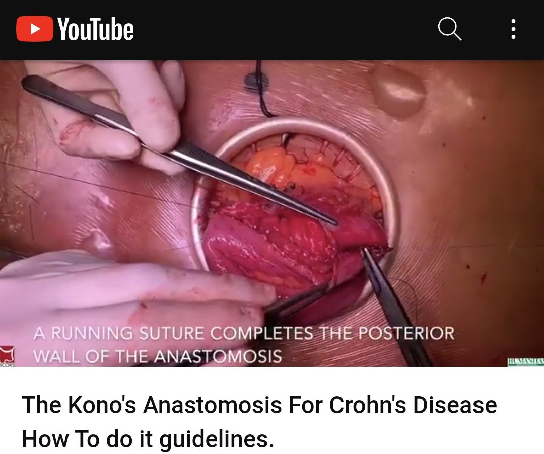 #CoDiSundays 📖☕

@escp_tweets and @ColorectalDis watch the video on how to do #Kono-s anastomosis. Watch with us  here👇🏽👇🏿👇👇🏽

youtube.com/watch?v=Dg0QB1…