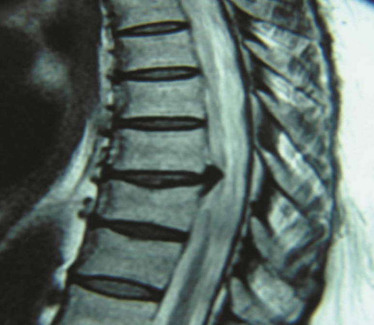 drdozellodc's tweet photo. Thoracic Spine Disc Herniation and Thoracic Spine Disc Bulge
Dr Donald A Ozello DC of Championship Chiropractic
#thoracic #thoracicspine #thoracicdischerniation #discherniation #thoracicdiscbulge #discbulge #midback #micbackpain #herniation #chiropractor https://t.co/I0ZEWscwiD https://t.co/R2ZF20Rjvr