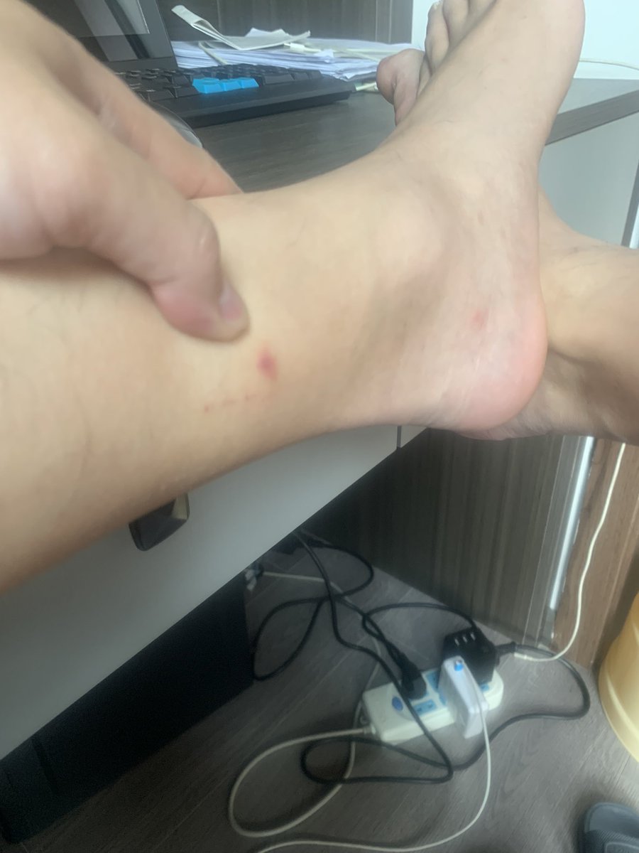 JamesCageWhite's tweet photo. What’s on my foot . Is it aids or something? https://t.co/o5MFO1O2lp
