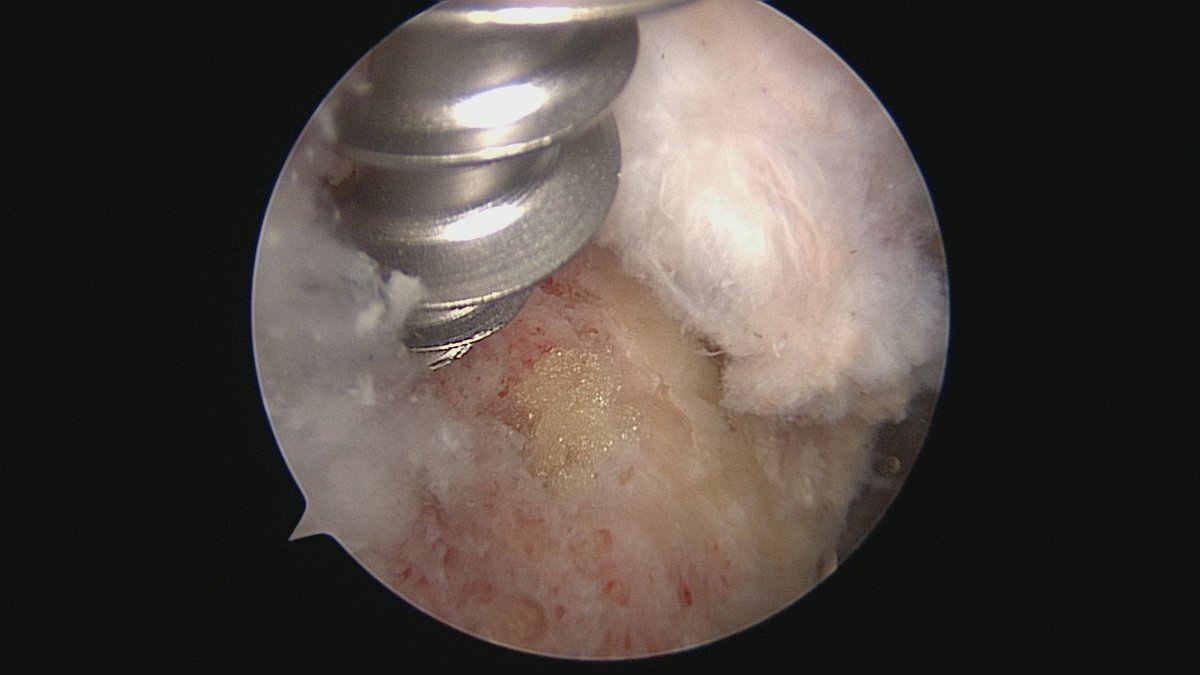 hip rotator cuff tear， a common cause of lateral hip pain， was found in women's 50-80s period. just like a shoulder RCT repair two anchors fix the loosening abductor. #hiparthroscopy