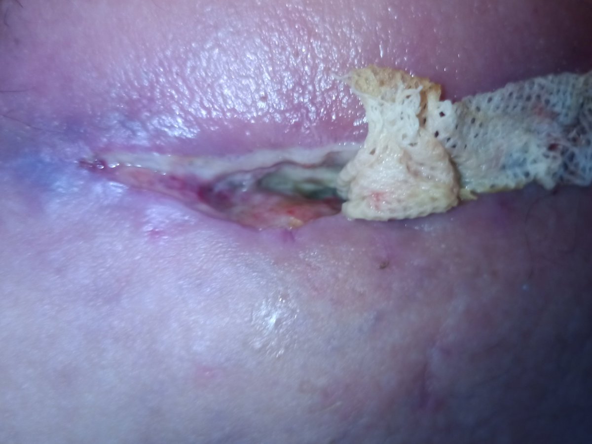Another orifice to be closed today. Wish me luck 🤞