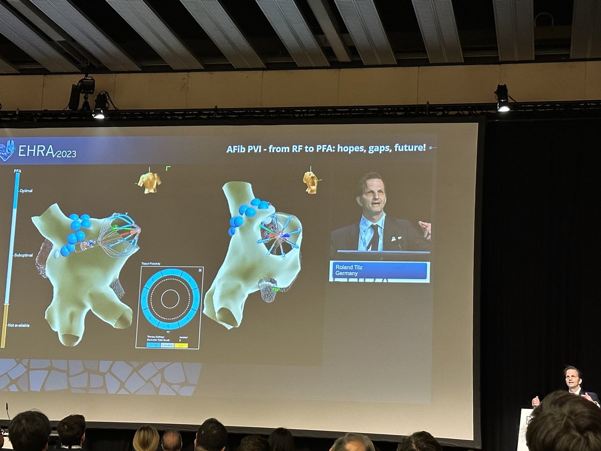 sachinjv's tweet photo. Prof Tilz shared his thoughts on why 2nd gen PFA devices may solve todays problems to improve outcomes. https://t.co/wTO5pGFqZf