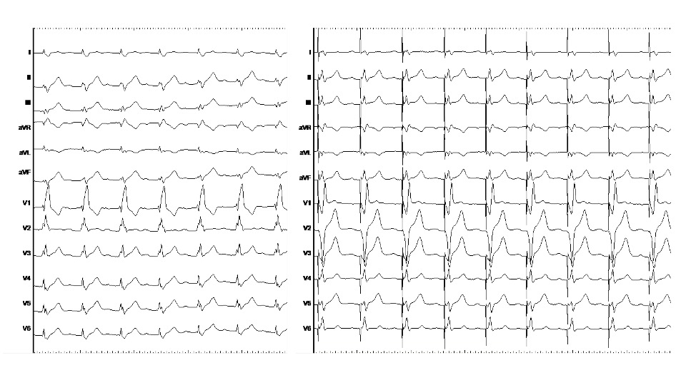Óscar Cano (@ocanoperez) on Twitter photo It was a real privilege to perform a live case at #EHRA2023 from <a href="/HospitalLaFe/">HospitalLaFe</a>. Tough case of a GUCH patient (s/p pulmonary atresia+VSD). A great team effort from <a href="/joaquinosca/">joaquin osca</a> @Maite_izquierdo <a href="/JNavarromanchon/">Josep NavarroManchon</a>. Here is the final result. What do you think?<a href="/curilakarol/">curilakarol</a> <a href="/HaranBurri/">Haran Burri</a> It was a real privilege to perform a live case at #EHRA2023 from <a href="/HospitalLaFe/">HospitalLaFe</a>. Tough case of a GUCH patient (s/p pulmonary atresia+VSD). A great team effort from <a href="/joaquinosca/">joaquin osca</a> @Maite_izquierdo <a href="/JNavarromanchon/">Josep NavarroManchon</a>. Here is the final result. What do you think?<a href="/curilakarol/">curilakarol</a> <a href="/HaranBurri/">Haran Burri</a>