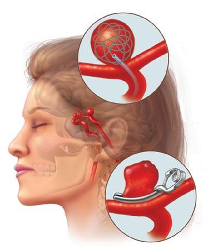 Jordi de Winkel (@winkeljordi) on Twitter photo At 12:00 during the <a href="/ErasmusMCPH/">Erasmus MC Public Health</a> Monday meeting the CMB section will discuss benefit prediction"".
๐ฉธ1) The optimal #aneurysm treatment strategy in patients with aSAH.
๐2) Predicting the individualized treatment benefit of IVT before EVT in ischaemic #stroke patients. At 12:00 during the <a href="/ErasmusMCPH/">Erasmus MC Public Health</a> Monday meeting the CMB section will discuss benefit prediction"".
๐ฉธ1) The optimal #aneurysm treatment strategy in patients with aSAH.
๐2) Predicting the individualized treatment benefit of IVT before EVT in ischaemic #stroke patients.