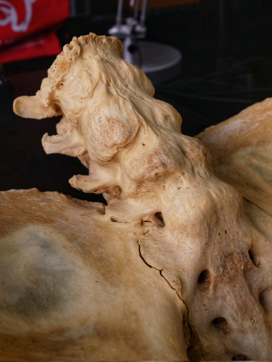 Yas_Avia's tweet photo. Espondilitis anquilosante en vértebras lumbares de gorila @ZooBarcelona

La fusión de las vértebras provoca muchos problemas en humanos, pero en primates cuadrúpedos, la rigidez derivada de esta patología es más una ventaja que un inconveniente. 

📍 @museuciencies 
📷 G. gorilla https://t.co/eQJ0geYPvc