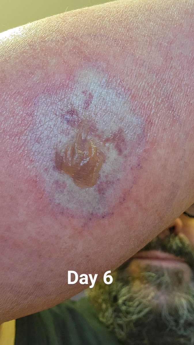 It's amazing what the bite of a #brownrecluse spider can do!
#spider
#spiderbite