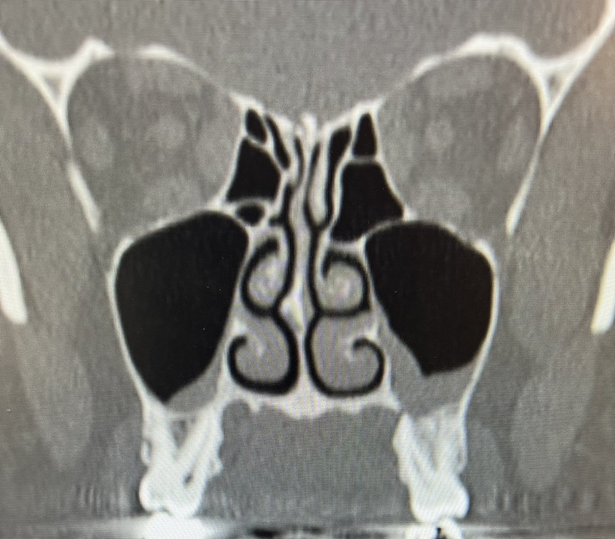John Craig, MD (@johncraignose) on Twitter photo A periodic tweet how this is NOT #ODS never hurts. If you see this, it’s most likely just a root canal or extraction away from success. Unless they’ve developed purulent sinusitis after the CT, then it could be #ODS. 🤓😁 <a href="/henryfordent/">Henry Ford ENT</a> <a href="/ent_ams/">Alberto Maria Saibene, MD, MA</a> A periodic tweet how this is NOT #ODS never hurts. If you see this, it’s most likely just a root canal or extraction away from success. Unless they’ve developed purulent sinusitis after the CT, then it could be #ODS. 🤓😁 <a href="/henryfordent/">Henry Ford ENT</a> <a href="/ent_ams/">Alberto Maria Saibene, MD, MA</a>