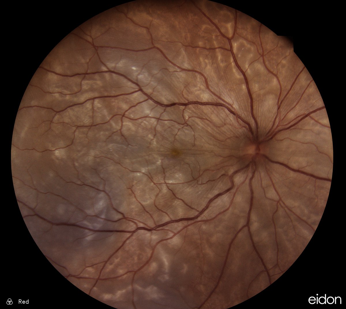 Aprils Image of the Month shows Vogt-Koyonagi-Harada Disease, which is a bilateral granulomatous panuveitis affecting primarily pigmented races. #VogtKoyonagiHaradaDisease #retinaldisease #retina #retinaspecialist #RetinaConsultantsofTexas #RCTX #PreservingYourVisionIsOurMission