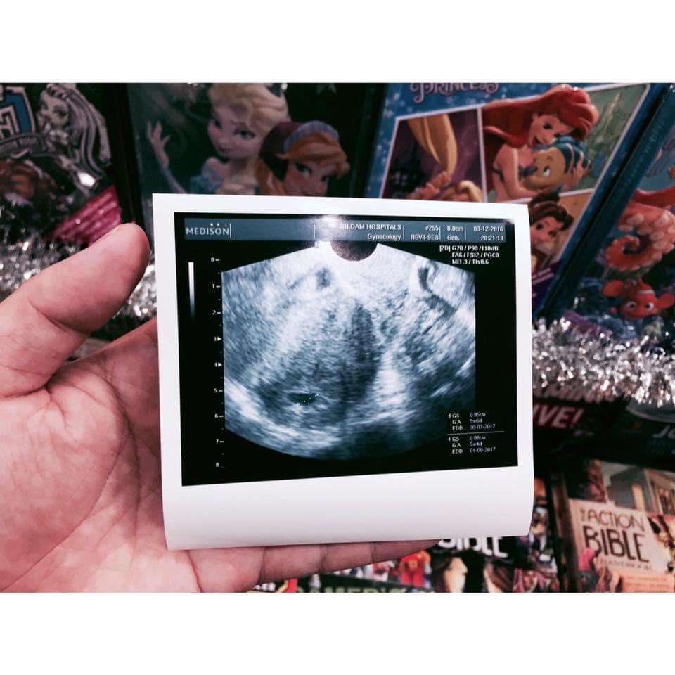 Orang2 gk percaya Tuhan ya monggo. Tapi gw gmana gk mau percaya Tuhan itu ada. 

Istri gw divonis harus operasi angkat ovarium kanan krma endometriosis. Salah satu cara agar tdk operasi adalah istri gw hamil. Padaha chance istri gw hamil itu 1% krna ada kista coklat.