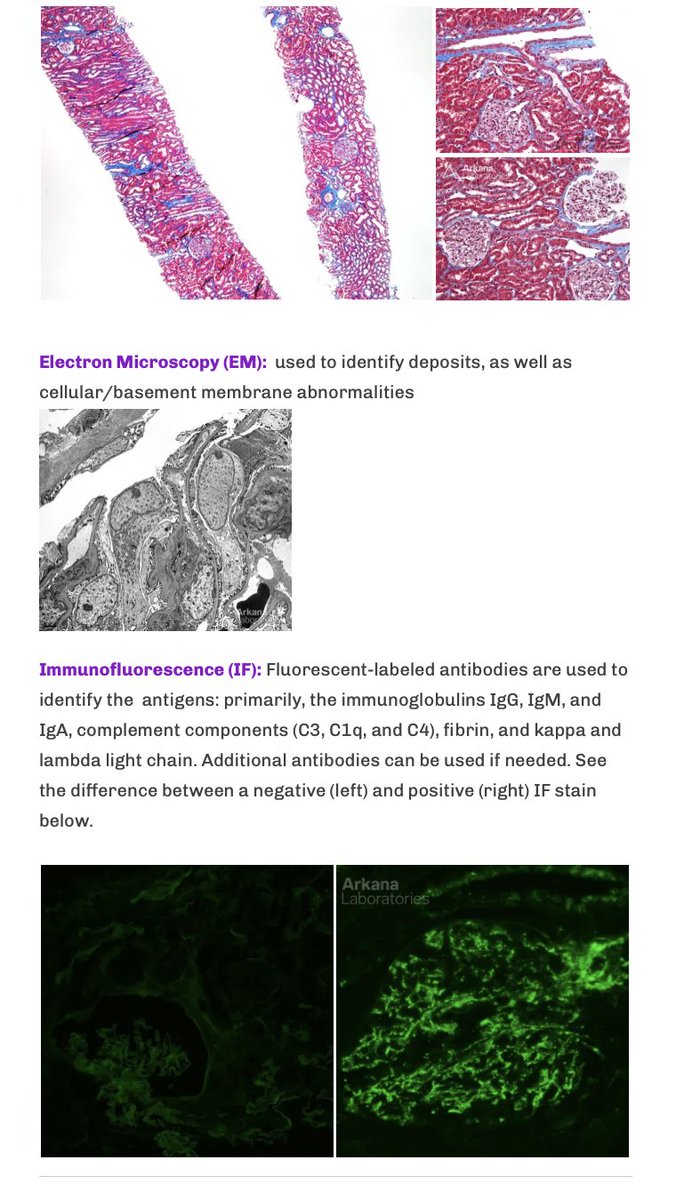 Neph_SIM's tweet image. Our initial approach to a #kidneypath slide:

1. 🎨
2. Loops ope?
3. Bowman’s space open?
4. Mesangial space expanded?
5.  Proliferation of mesangial/parietal/endothelial cells?
6. Tubules “back-to-back”? 

nephsim.com/pathology-appr…

In Spanish: nephsim.com/pato-101-2/

#FOAMed