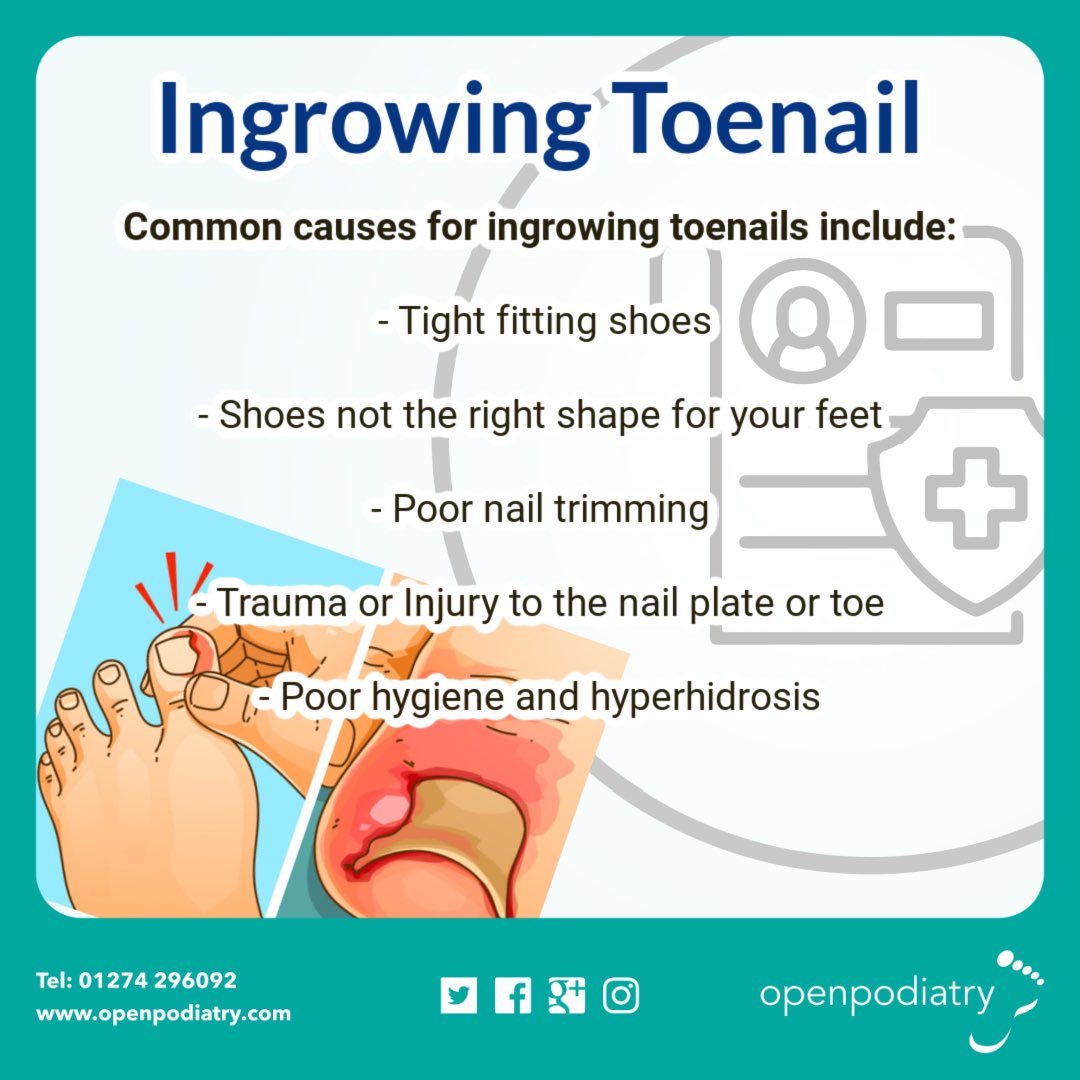 OpenPodiatry's tweet photo. Learn about ingrowing toenails
Don’t suffer in silence Often leaving the problem too long can result in the condition worsening
Contact us.
#feet #Bradford #footpain #likeforlikes #retweet #openpodiatry #painfulfeet #nailsurgery #ingrowingtoenail #toenailsurgery #nailspike https://t.co/4ZZ5PXTx4K