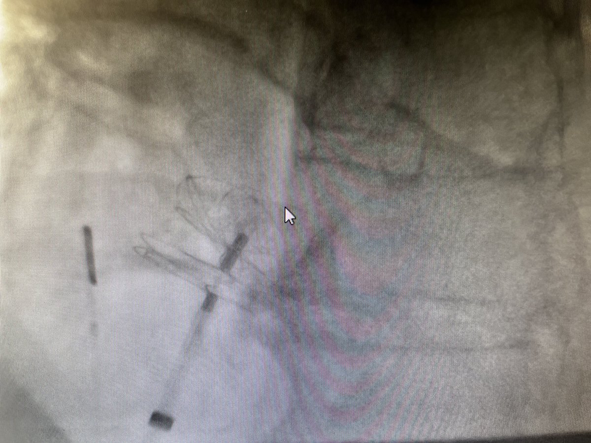 KinturSanghvi's tweet photo. A 50-55yrs retired cop had cerebellar CVA after a 5 hour flight. Identified patent foremen ovale (PFO). ROPE score 7. 2 local cardiologist didn’t offer treatment due to risk?!! Closed in 40 minutes and 4 hrs hospital stay. More effort needed On education.#CVA #TIA #cardiotweeter https://t.co/vfRLmKbsXO
