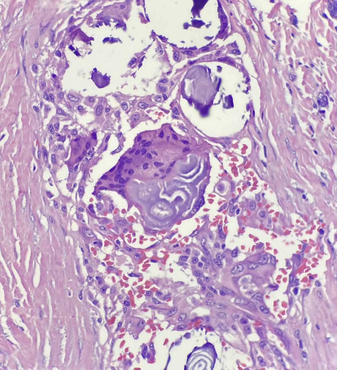 beatriz_frt's tweet photo. Those psamomma bodies gotta taste good 🍽️
▪️Multinucleated giant cells are a quite common in papillary thyroid carcinomas
▪️ Finding them on a coloid-poor FNA of a solid lesion can help raise your suspicion for malignancy
#pathology #pathtwitter #pathresidents #thyroidpathology https://t.co/soIwTibgmf