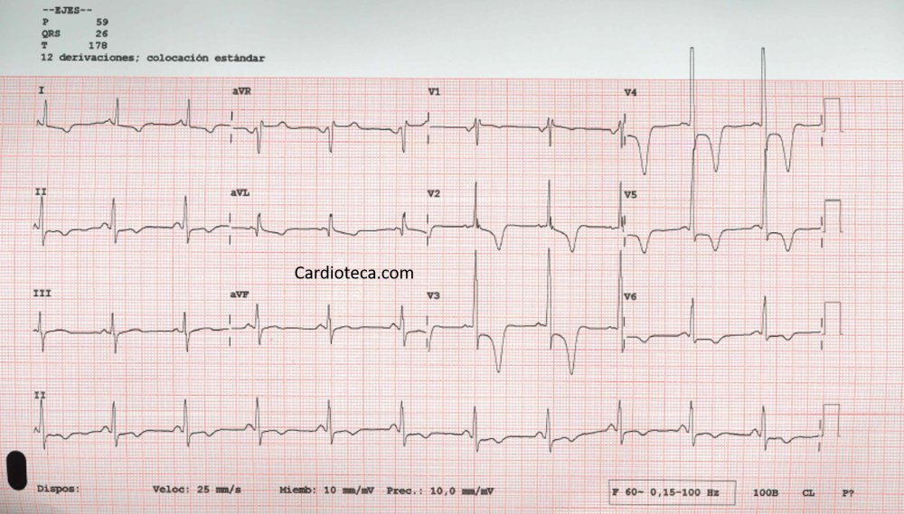 cardioteca's tweet photo. 🆕❤️ #ECGCardioTeca 523 - Último paciente de la consulta, chico 30 años, acude enviado por su médico porque en una revisión deportiva, estando asintomático, le han dicho que tiene un #ECG raro. ¿Dolencia?

👉 https://t.co/xykIJWJ21z

#cardiologia #cardiotwitter @HiguerasJavier https://t.co/EaX7wVxVoS