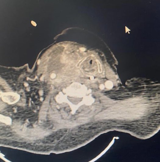 Solo 15 días de tratamiento con dabrafenib + trametinib en una paciente con un tumor anaplásico de tiroides V600E positivo