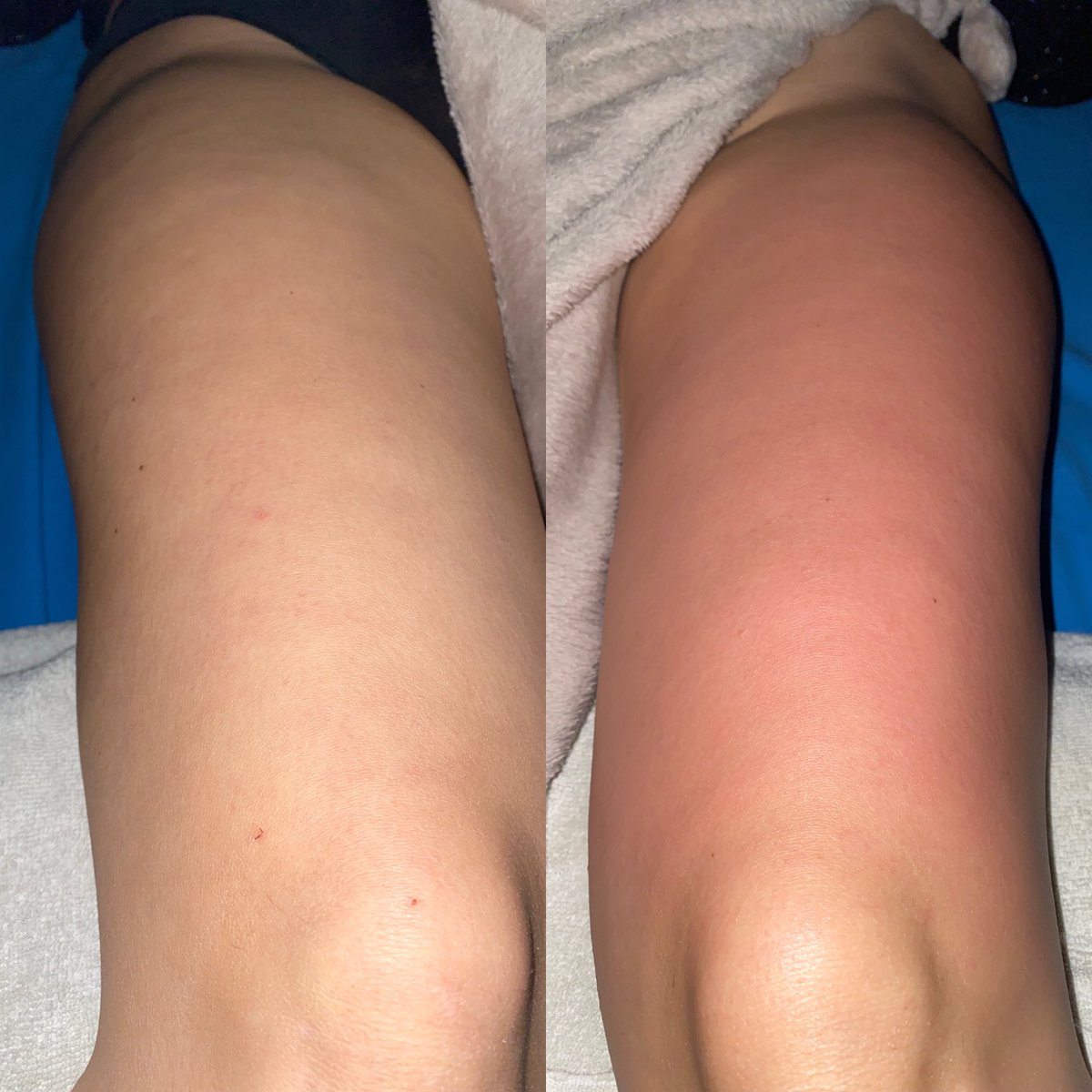 MarkMasseur's tweet photo. Another day another anticellulite massage 🙃 #massage #aftertraining #homespa #spa #legs #legsday #legday #football #beautiful #derm #skincare #health #uk #scotland #glasgow #ScottyfromMarketing https://t.co/8TxOO5q57l