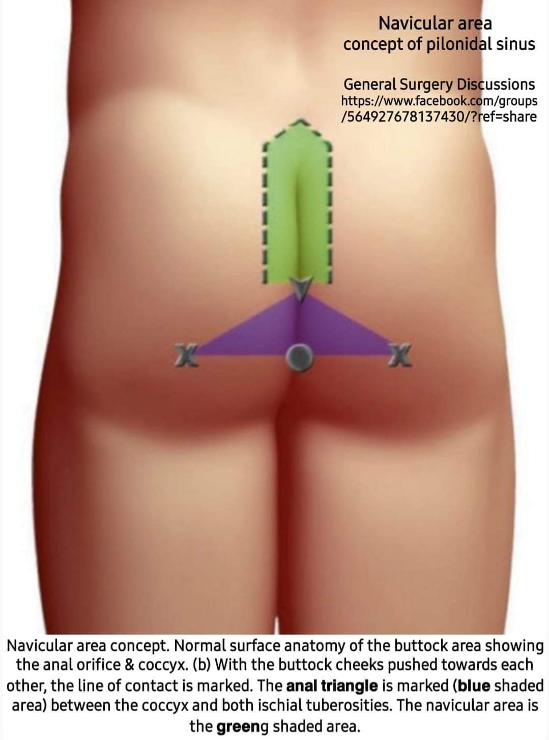 DR AFTAB AHMED on X: 𝗡𝗮𝘃𝗶𝗰𝘂𝗹𝗮𝗿 𝗮𝗿𝗲𝗮 (anal triangle) concept,  Class wise management of Pilonidal sinus, Approach algorithm for infected pilonidal  cyst & Main primary wound closures techniques in pilonidal cyst: Ref