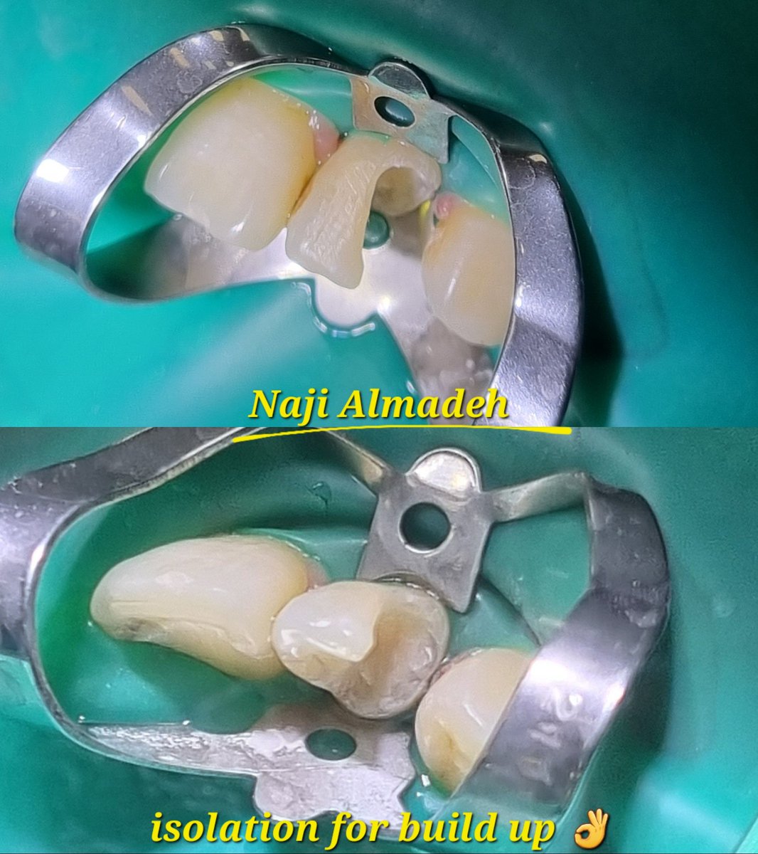 naji3x_m's tweet photo. تم معالجة السن الأمامي، علاج جذور وتنظيف القناة وحشوها باتقان عند الدكتور @Dentist_Ahmed8  شكرً د. أحمد 🫡😍👌

واكملت الحالة: أولًا رممت الجزء المتضرر من السن بعد استخدام العازل المطاطي ✅️
- ثم تحضير السن لاستقبال التلبيسة واخذ المقاسات
- واخيرًا تلبيس السن 👑🦷 https://t.co/Eu1NuMJyaP