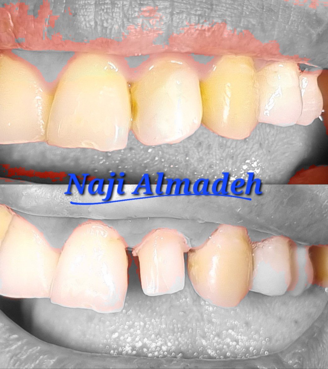 naji3x_m's tweet photo. تم معالجة السن الأمامي، علاج جذور وتنظيف القناة وحشوها باتقان عند الدكتور @Dentist_Ahmed8  شكرً د. أحمد 🫡😍👌

واكملت الحالة: أولًا رممت الجزء المتضرر من السن بعد استخدام العازل المطاطي ✅️
- ثم تحضير السن لاستقبال التلبيسة واخذ المقاسات
- واخيرًا تلبيس السن 👑🦷 https://t.co/Eu1NuMJyaP