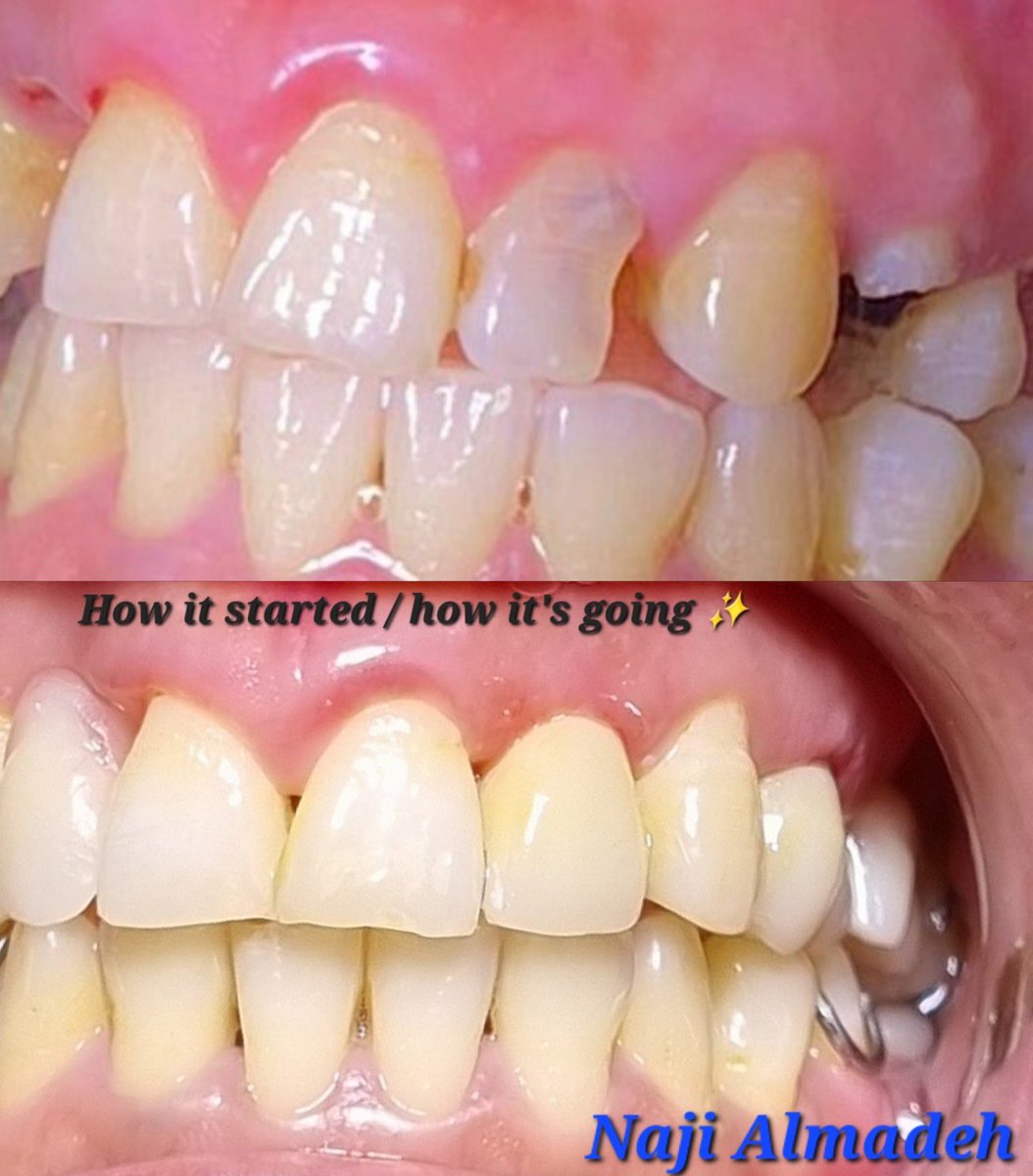naji3x_m's tweet photo. تم معالجة السن الأمامي، علاج جذور وتنظيف القناة وحشوها باتقان عند الدكتور @Dentist_Ahmed8  شكرً د. أحمد 🫡😍👌

واكملت الحالة: أولًا رممت الجزء المتضرر من السن بعد استخدام العازل المطاطي ✅️
- ثم تحضير السن لاستقبال التلبيسة واخذ المقاسات
- واخيرًا تلبيس السن 👑🦷 https://t.co/Eu1NuMJyaP
