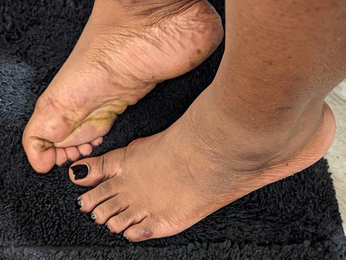 My arch is completely gone. I'ma wear my heels more or should I just go barefoot?? https://t.co/K2Ro<a href="/tag/bigolive"class="tags"><span>#bigolive</span></a>