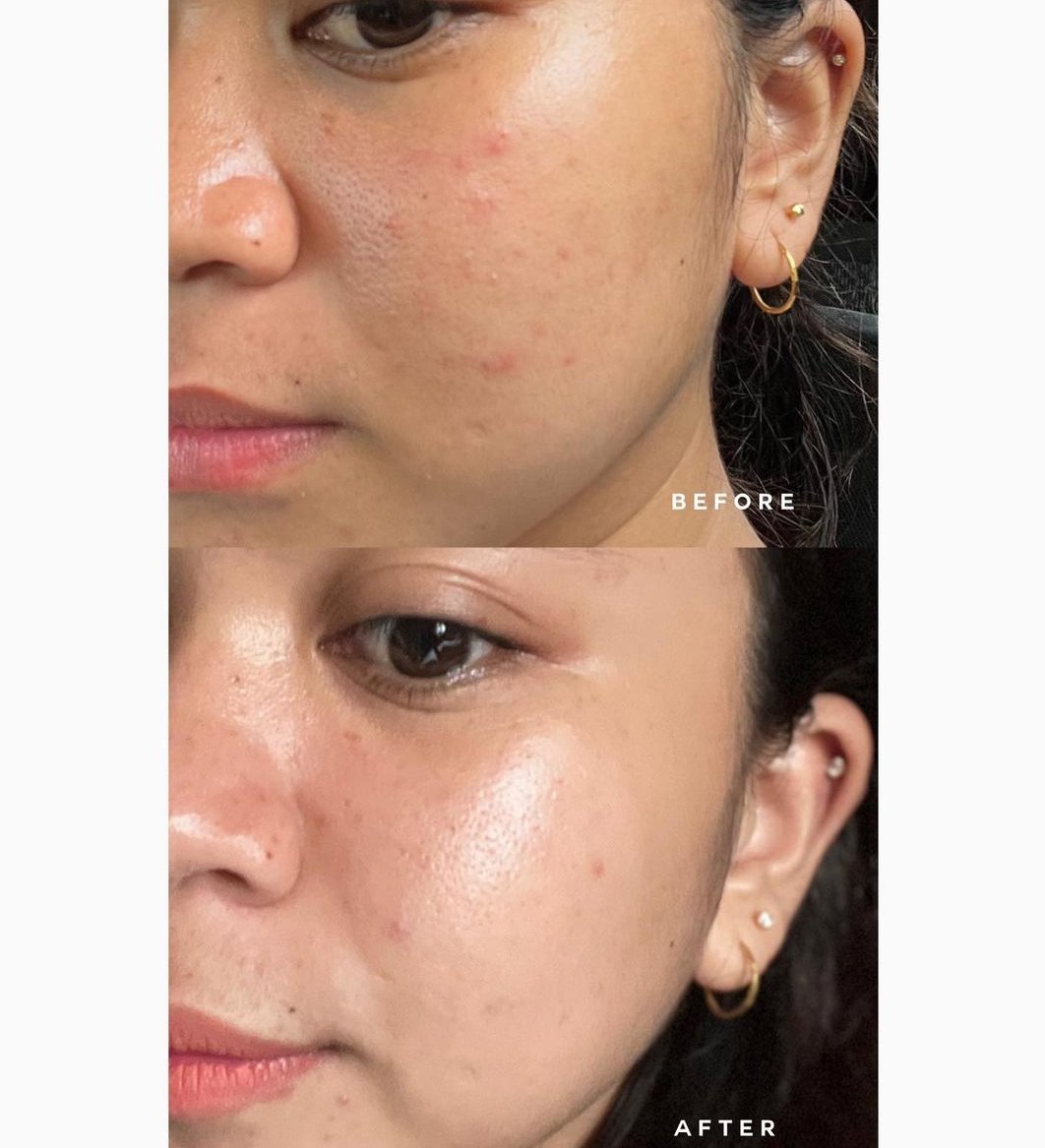 xtsh__'s tweet photo. Redness makin kurang ? Yes here proof of testimony this girl use Cella Grail Cleansing Gel ✨
Our #TehBunga cleanser formulated to clean our skin, anti inflammatory property, soothes skin irritation and inflammation 🌼 https://t.co/8IfJg6kHfA