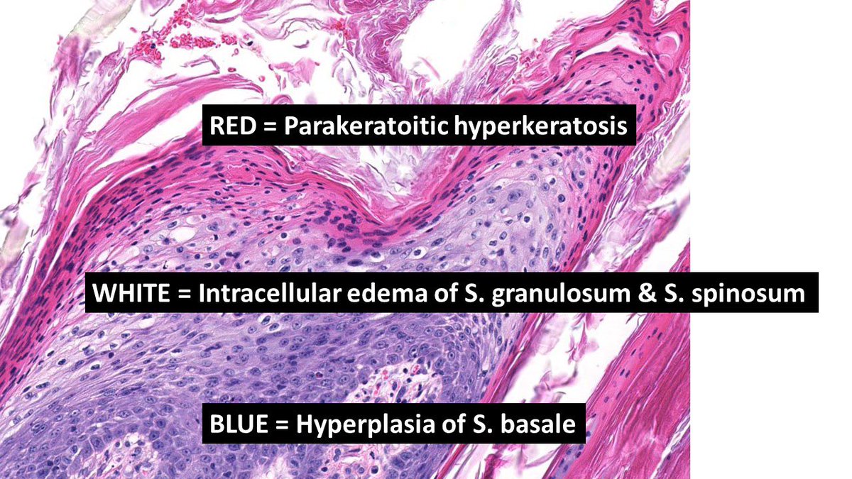 Superficial necrolytic dermatitis: A cutaneous manifestation of internal disease.

🚨’Textbook case’ histo: “Red, white, & blue” laminar epidermal pattern due to 3 key features: 

✅Parakeratosis 
✅Superficial epidermal keratinocyte vacuolar degeneration
✅Basal cell hyperplasia