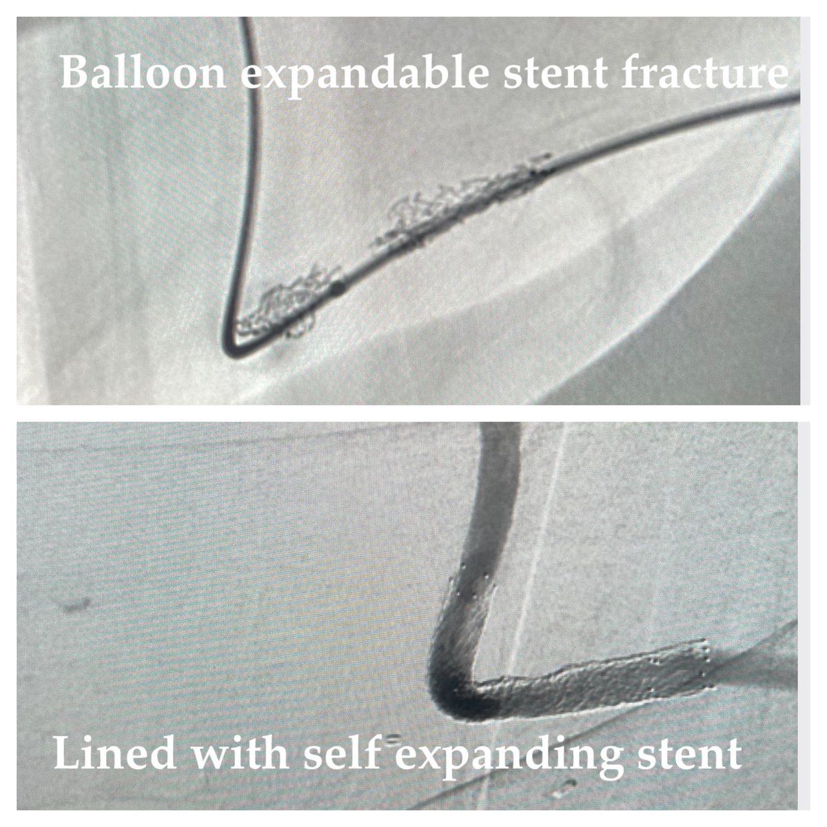 Ambarish Bhat (@bhat_ambarish) on Twitter photo Balloon mounted stents cannot withstand torque/ compressive forces. This graft went down in a week of stent implant at the venous anastomosis..had to thread the lumen of the fractured stent and line it with SES! <a href="/SIR_ECS/">SIR ECS</a> <a href="/SIRspecialists/">Society of Interventional Radiology</a> <a href="/ISVIRIndia/">ISVIR India</a> <a href="/CAIRweb/">Canadian Association for Interventional Radiology</a> <a href="/w_bryan52/">wbryan</a> <a href="/SIRRFS/">SIR RFS</a> Balloon mounted stents cannot withstand torque/ compressive forces. This graft went down in a week of stent implant at the venous anastomosis..had to thread the lumen of the fractured stent and line it with SES! <a href="/SIR_ECS/">SIR ECS</a> <a href="/SIRspecialists/">Society of Interventional Radiology</a> <a href="/ISVIRIndia/">ISVIR India</a> <a href="/CAIRweb/">Canadian Association for Interventional Radiology</a> <a href="/w_bryan52/">wbryan</a> <a href="/SIRRFS/">SIR RFS</a>
