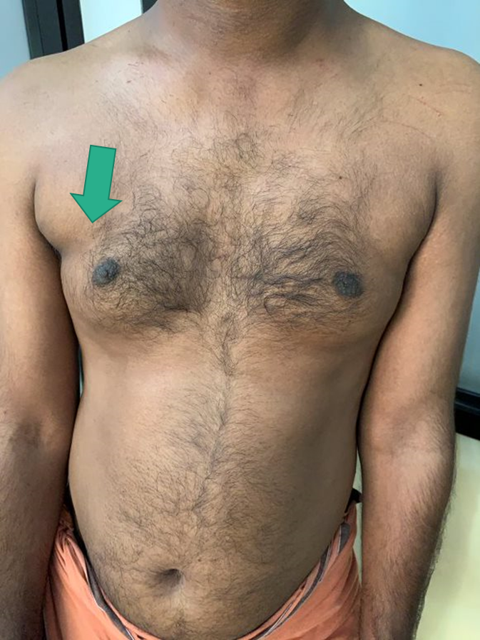 Anterior Axillary Fold