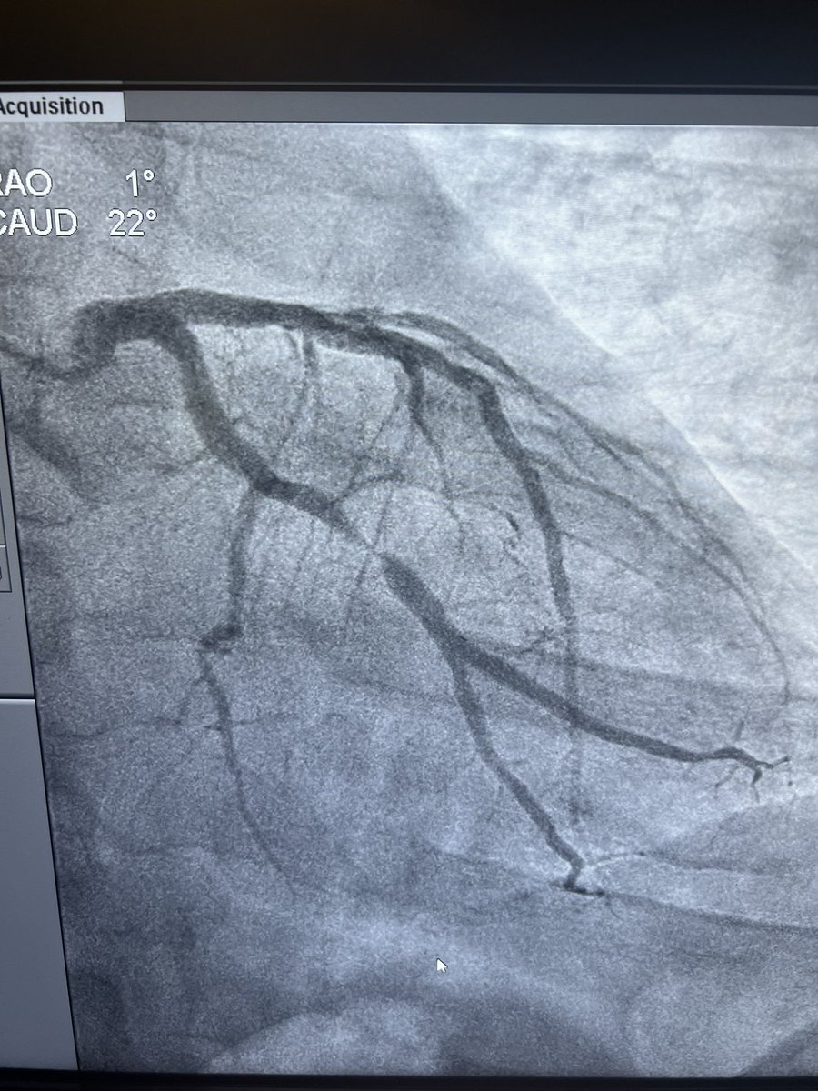 A rare beast found in the wild…. #TypeA #TheydoExist #Cardiotwitter @JasonGKaplanMD