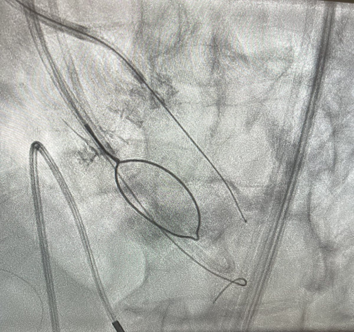 drmomani's tweet photo. How do you deal with heavily calcified bioprosthetic valve leaflet during BASILICA? Trifecta VTC 2.5 mm @CathElectroSurg @AdamGreenbaumMD @jtsaxon @akcmahi @MohammedQintar @BillONeillMD @kalazizimd @SachinGoelMD 
Took multiple attempts 2 or 3 Astato wires to traverse the leaflet https://t.co/cUb2lVQlpq