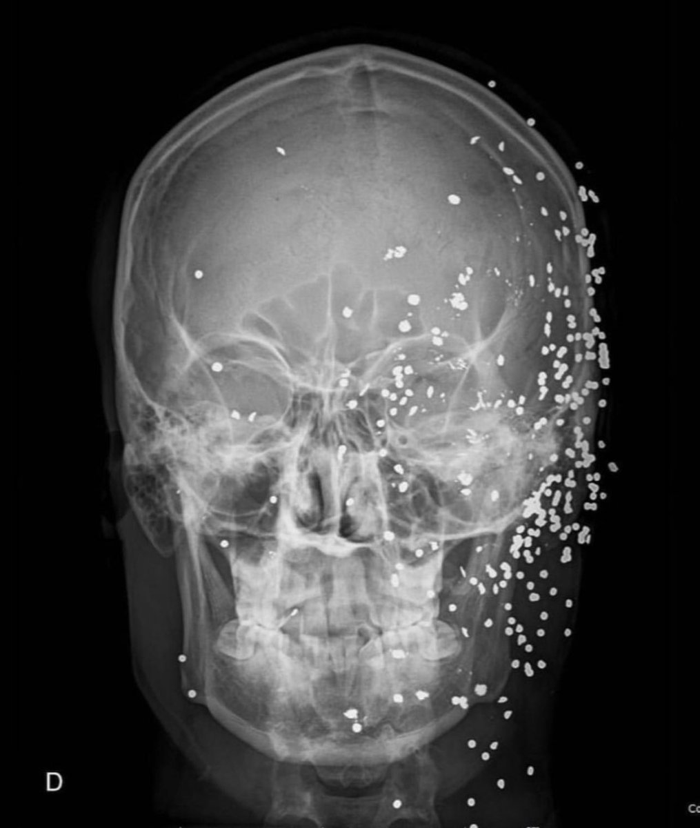 Este caso muestra a un hombre de 20 años que fue golpeado accidentalmente en la cara con perdigones de una escopeta.

 Afortunadamente sobrevivió, pero desafortunadamente sufrió la ruptura de los globos oculares por los perdigones y perdió la visión en ambos ojos.