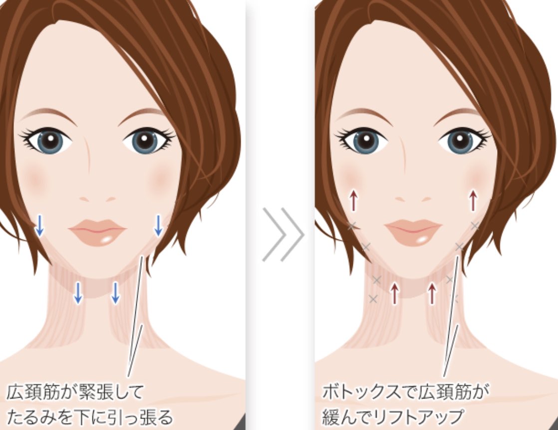 _am1chan's tweet photo. 初めて広頚筋ボトックス(ボトックスリフト)打ってきた！フェイスラインがくっきりしたり、人によっては首が長く見えるようになるらしい。ヘアケアクリニックで2万くらいだった！期待🥺💓 https://t.co/GPC0NBGR5I