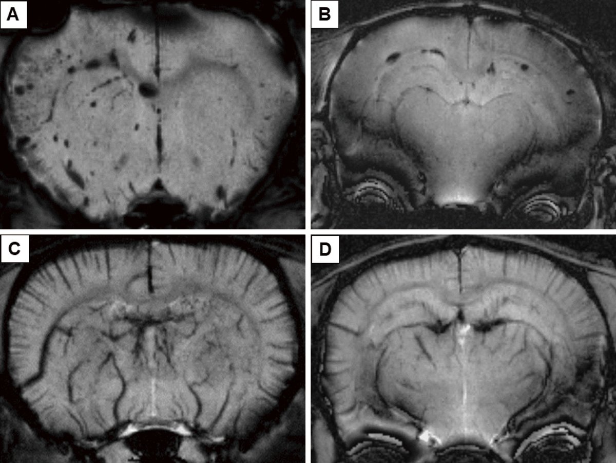 nmc_jns's tweet photo. New Arrival: Microbleeds Due to Reperfusion Enhance Early Seizures after Carotid Ligation in a Rat Ischemic Model
https://t.co/dmLsqKM1aw
#Epilepsy #Reperfusion #Hyperperfusion #Seizure #BilateralCarotidArteryLigation #BrainIschemia https://t.co/GIYiOrJtUN