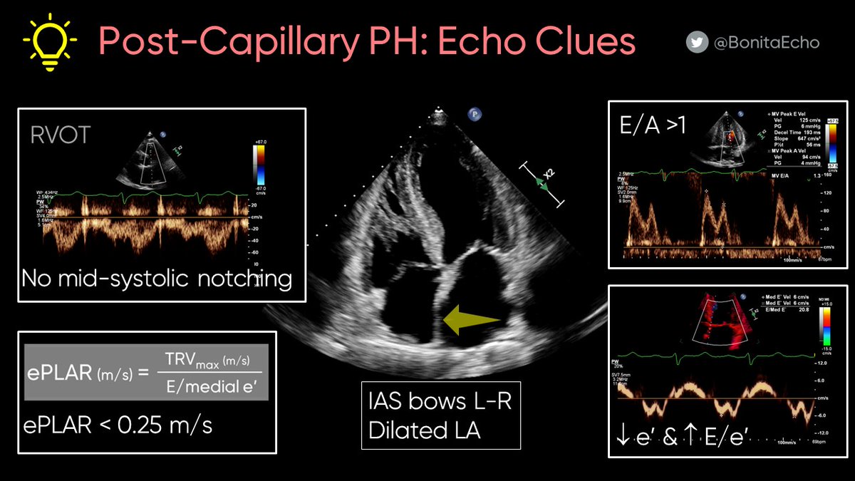 Distinction between pre- &amp; post-capillary pulmonary hypertension is important for guiding therapy. Here are some echo clues to help distinguish between these levels of PH. 
More info about ePLAR: Int J Cardiol. 2016 Jun 1;212:379-86. doi: 10.1016/j.ijcard.2016.03.035 
#echofirst