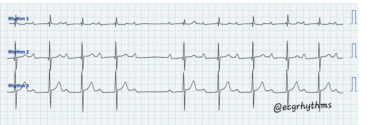ecgrhythms's tweet photo. 040523

From the📦/📧 by a 🫂
Difficulty level (out of 5⭐️): ⭐️⭐️
Digitized using @PMCardiobot

What is your  rhythm interpretatiom? Poll next

#FOAMed 
#MedEd 
#MedTwitter 
#CardioTwitter 
#EPeeps https://t.co/nL4QDJ8Nbn