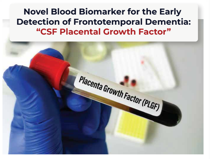 DrscEditorial's tweet photo. The new study imply that PlGF presents a very promising biomarker for the early identification of Frontotemporal Dementia (FTD). 

Read full article at- https://t.co/4J1dtLkyaI

For more info reach us at- https://t.co/7MQ4VUH67V
#dementia #csf #placenta #growthfactors #neurology https://t.co/rZu4MUzMrM