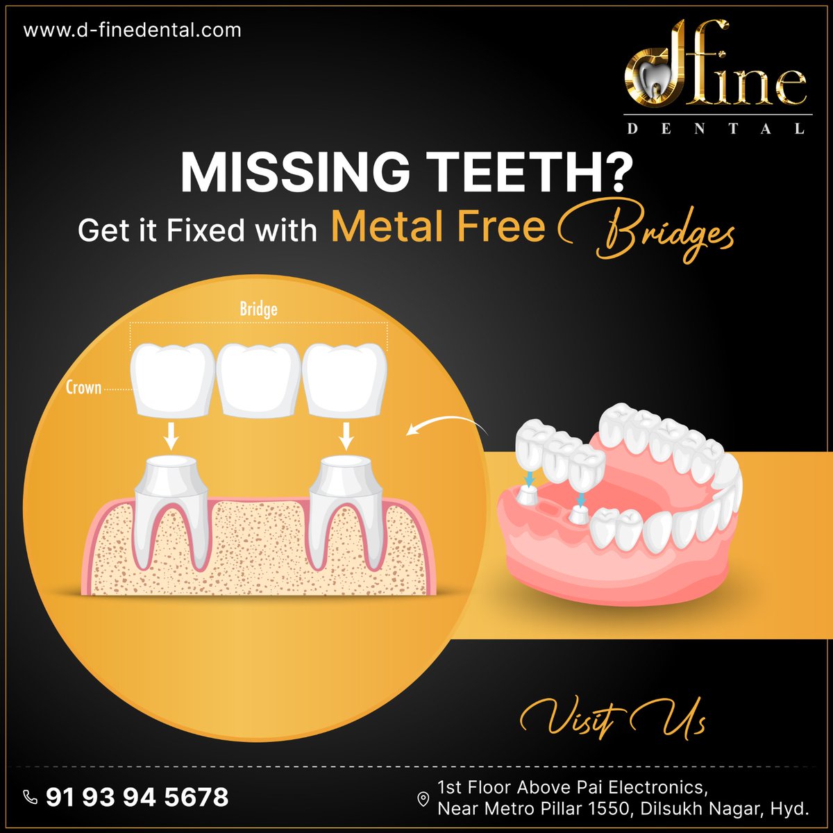 dfinedental's tweet image. Dfine Dental Hospital is an excellent choice for Dental Crown Treatment in Dilsukhnagar. 

Click Here for More Info: d-finedental.com/crown-and-brid…

#dentalcare #DentalDoctor #dentaldisease