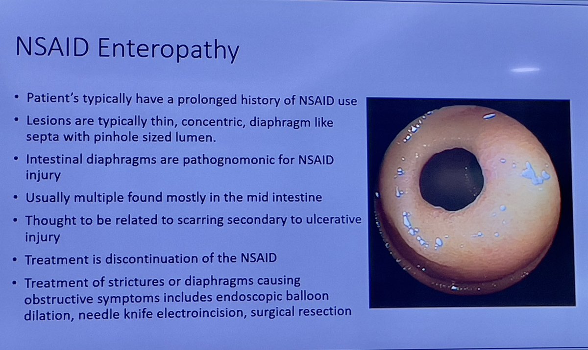 HolubarStefan's tweet photo. @IBDLive #IBDLive 1st case  @YaleMed #crohnsdisease diffuse jejunoileitis - beware of mimics - CMUSE, GI TB, NSAID strictures ; note strictureplasty originally described for GI TB!  #SoMe4Surgery #SoMe4IBD #IBDSurgery https://t.co/1LI8wHbuiz