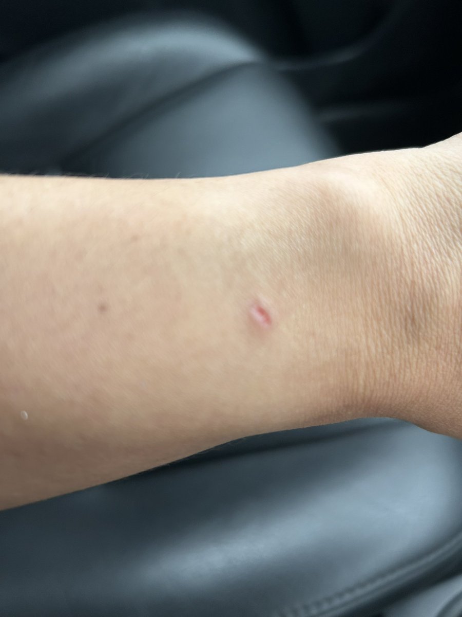 airaniss's tweet photo. After years of hesitation, I finally made the bold decision to buy an Apple Watch. Guess what, it burned me! @Apple Support is taking far too long to provide any kind of real support so I’m going to try to return the blardy Watch. Wish me luck! #AppleSoldMeALemon https://t.co/umvwhSwSAO
