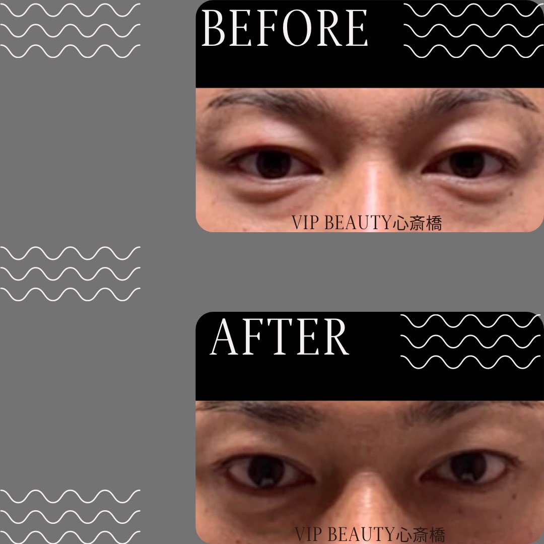 お客様の施術前、施術後のお写真です。
目の開きに注目です！
黒目の見える範囲が広くなりました！
色素沈着、目の下のたるみ、
眼精疲労などが気になる方必見☆
施術後は目元が引き締まり
目の開きが格別に変化！
くすみをなくし
トーンアップも期待できます！
是非お試し下さい♪
VIPBEAUTY心斎橋