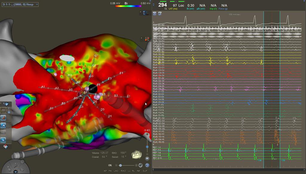 DrCherylTeresEP's tweet photo. Finally joined the Octa club! 🐙super nice atypical roof-dependent LA flutter on low-voltage area. Back in SR 1,7s into ablation. #CardioCHUV #EPeeps #EPbot #CardioTwitter @BiosenseWebster https://t.co/d8BGj1UW3v