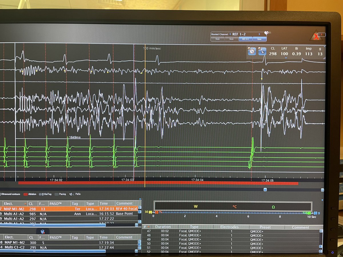 DrCherylTeresEP's tweet photo. Finally joined the Octa club! 🐙super nice atypical roof-dependent LA flutter on low-voltage area. Back in SR 1,7s into ablation. #CardioCHUV #EPeeps #EPbot #CardioTwitter @BiosenseWebster https://t.co/d8BGj1UW3v