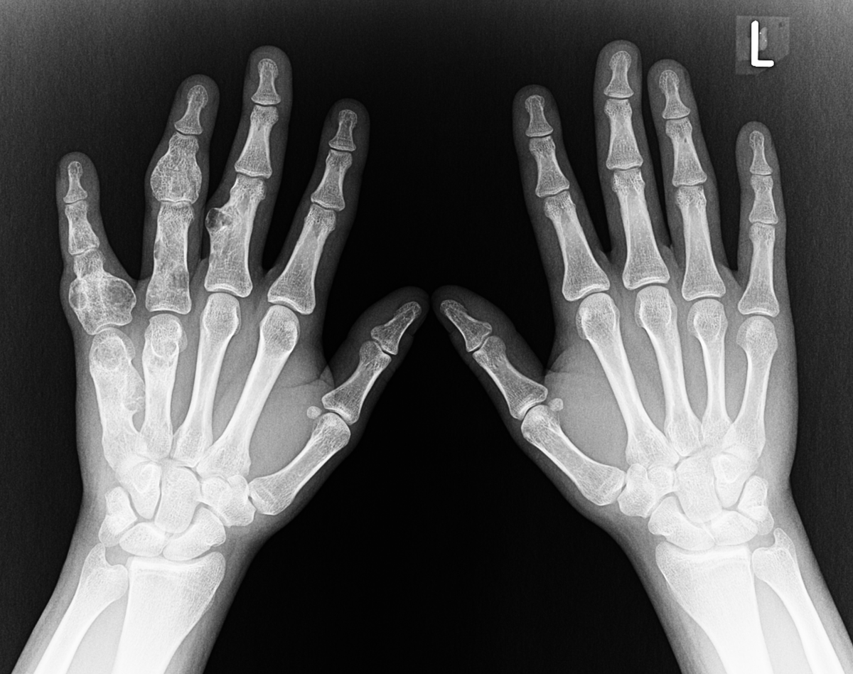 mskteachingroom's tweet photo. What is this radiograph demonstrating? 👀

#radfellow #radiologyfellow #radiologyresident #learningradiology #radres #mskrad #radtwitter #radiology #transformingradiology https://t.co/XPPNcxxSyG