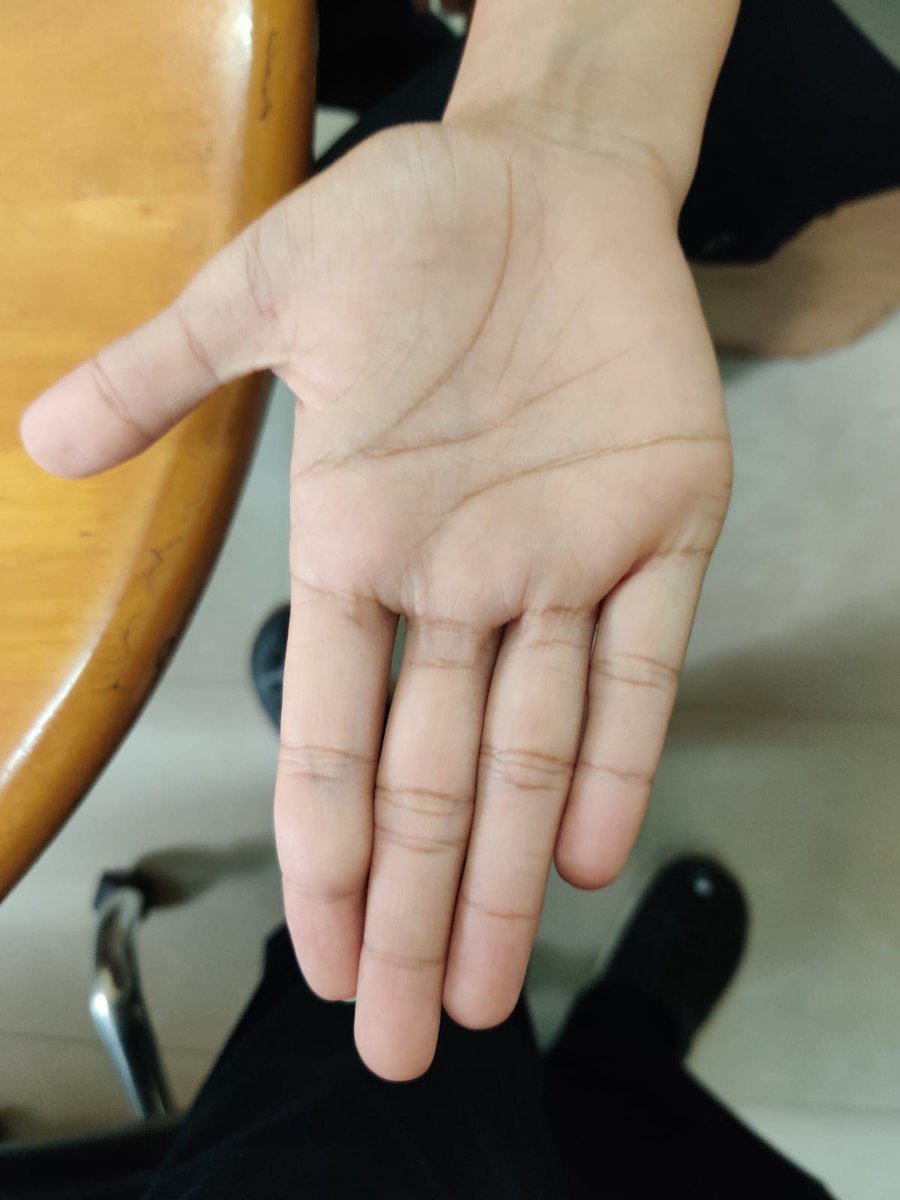 BharatS19581904's tweet photo. Painless slow growing Flexor surface finger swelling in a 20 year old. Though it is T2 hyper intense my intuition is a GCT tendon sheath. 
#orthotwitter #oncotwitter #orthoonco https://t.co/ycqjXEcthy