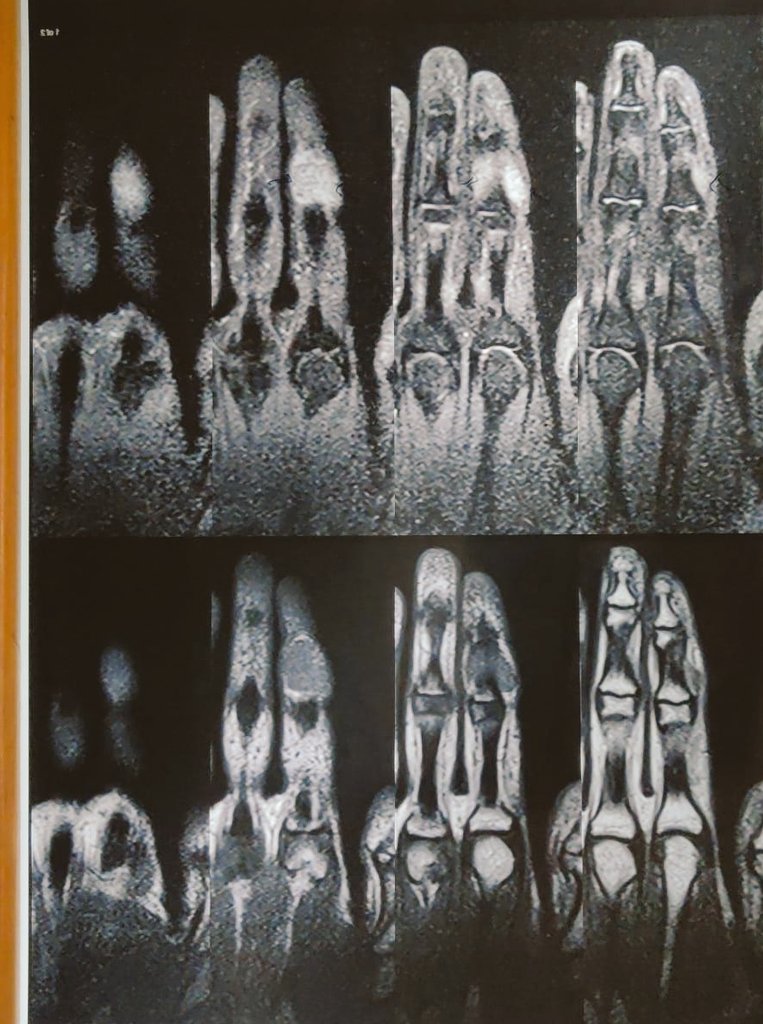 BharatS19581904's tweet photo. Painless slow growing Flexor surface finger swelling in a 20 year old. Though it is T2 hyper intense my intuition is a GCT tendon sheath. 
#orthotwitter #oncotwitter #orthoonco https://t.co/ycqjXEcthy