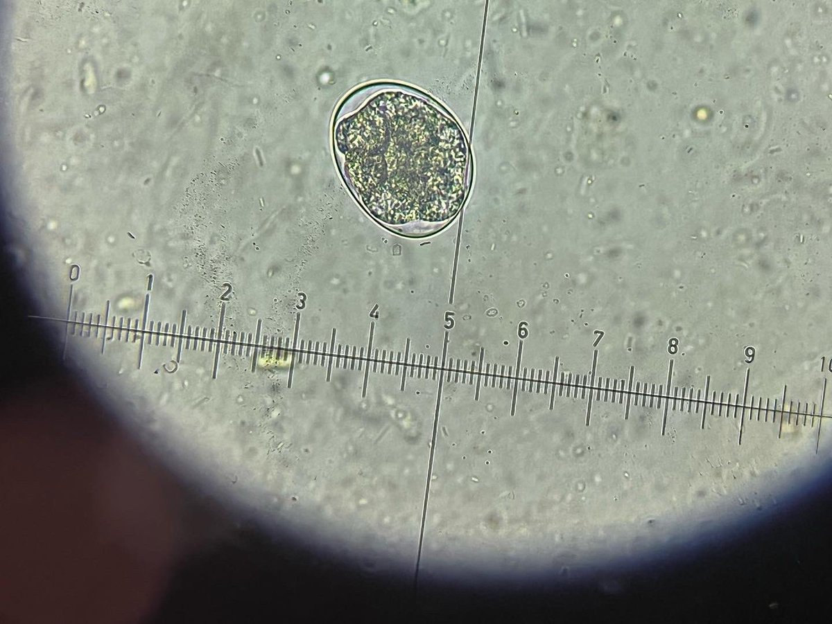 1IDCNMI's tweet image. ผู้ชายอายุ 20 ปี สนใจเรื่องการเพาะพันธุ์กัญชามากและ ลงทุนปลูกต้นกล้าหลากหลายพันธุ์ ทำเพาะพันธุ์จริงๆจังๆ ปรากฎว่าเจาะเลือดพบภาวะซีด (anemia) และมีเม็ดเลือดขาว Eosinophil สูง ทำให้สงสัยการติดเชื้อกลุ่ม Protozoa/helminth เลยตรวจอุจจาระ พบไข่ของพยาธิปากขอ (hookworm)