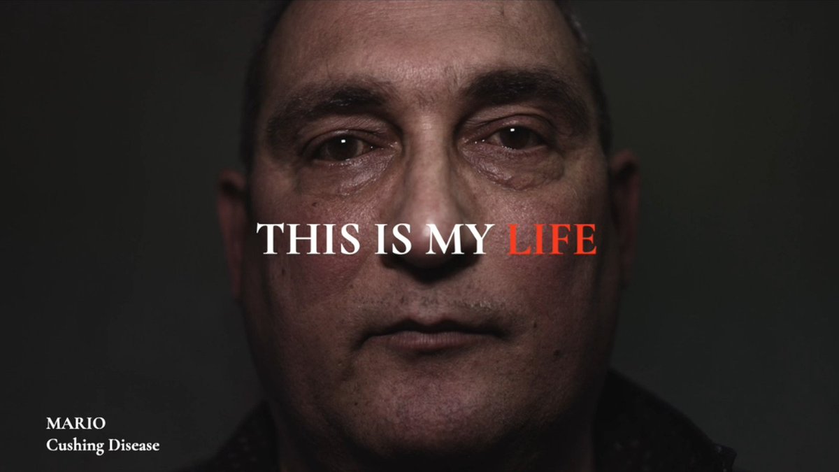 RecordatiD's tweet photo. Cushing’s syndrome symptoms can be so different from person-to-person. “Every single Cushing’s patient has a history. Every single patient suffers in a different way.”

Find out more: https://t.co/2b5gYCUnMv
Video: https://t.co/fNZH2GY2Pz

#ThisCushing #CushingAwarenessDay https://t.co/xFIkkLLDbE