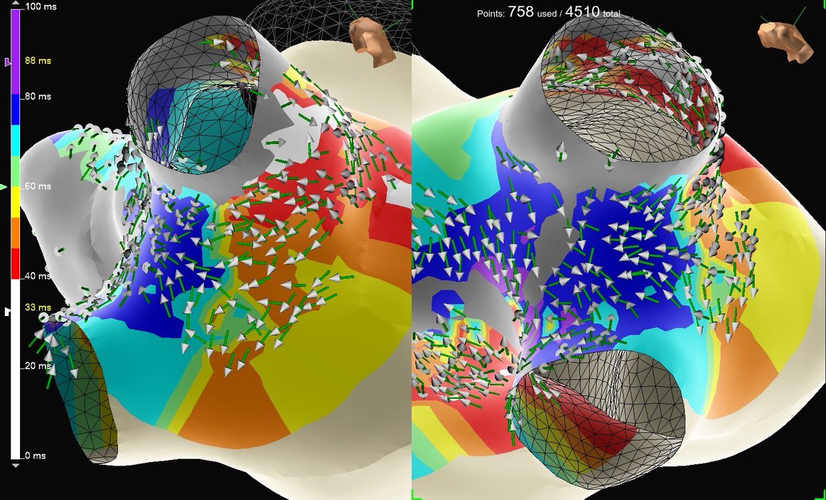 Mallory Taylor (@pvc_on_hers) on Twitter photo #EPeeps, emphasize what matters with #OTNearField detection and #PeakFreq overlay with #HDGrid on #EnSiteX. Single burn elimination of this discrete connection with #TactiCathSE.
#WelcomeToTheTParty <a href="/senthil_dorai/">Senthil Thambidorai</a> <a href="/AbbottCardio/">Abbott Cardiovascular</a> #EPeeps, emphasize what matters with #OTNearField detection and #PeakFreq overlay with #HDGrid on #EnSiteX. Single burn elimination of this discrete connection with #TactiCathSE.
#WelcomeToTheTParty <a href="/senthil_dorai/">Senthil Thambidorai</a> <a href="/AbbottCardio/">Abbott Cardiovascular</a>